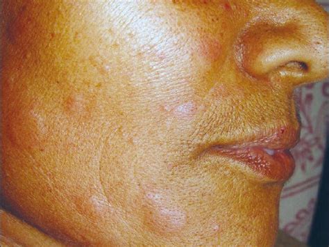 Hives On Face Treatments Symptoms Causes And Outlook