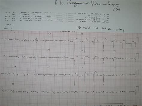 Tall, positive, hyper acute t waves in the ischemic vascular territory. Medical Images Gallery: Anterior Wall MI Reinfarct ECG Changes