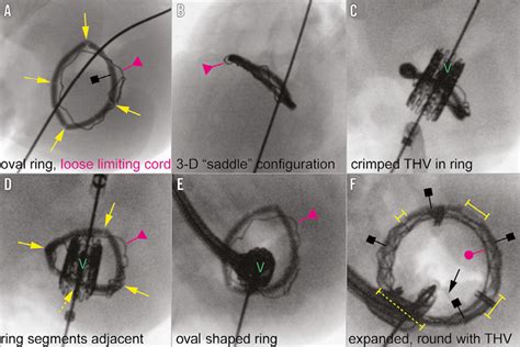 New Expandable Mitral Annuloplasty Ring Facilitates Transcatheter