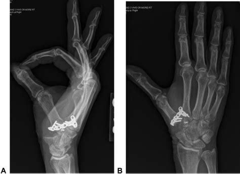 Failed Thumb Carpometacarpal Arthroplasty Common Etiologies And