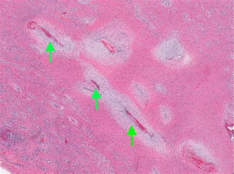 Pathology Outlines Nasopharyngeal Angiofibroma
