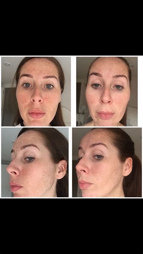 Freckle Removal Before And After Pulse Light Clinic London Using