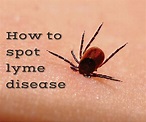 Ticks and Lyme Disease - Know The Symptoms of Lyme Disease | Lyme ...