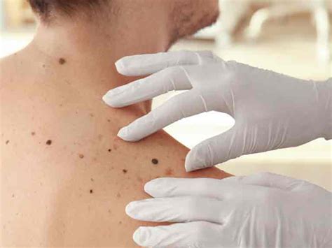 A Guide To Skin Cancers Saga Vrogue Co