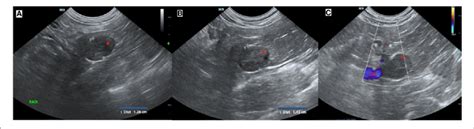 Ultrasound Images Of The Right Adrenal Mass A Initial Ultrasound