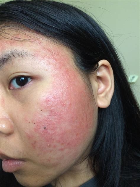 Allergic Reaction To Regimen Products By Han