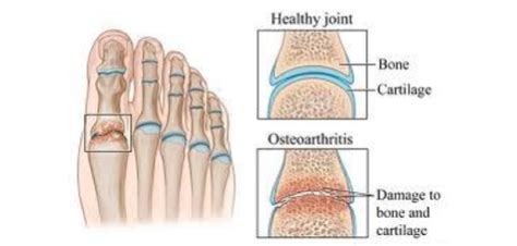 Osteoarthritis Of The Foot And Ankle San Mateo Podiatry Group