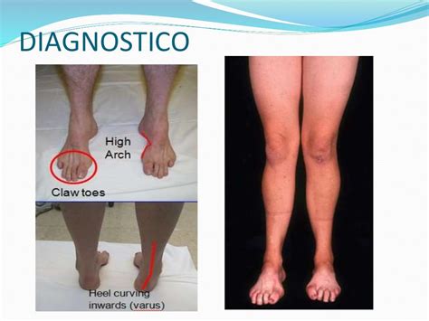 Doença De Charcot Marie Tooth Cid