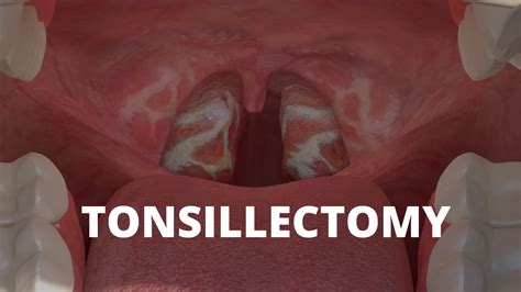 Tonsillectomy Video With Dr Brown Capital Ent And Sinus Center In