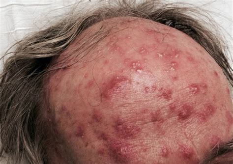 Crutchfield Dermatology December 2013 Case Of The Month