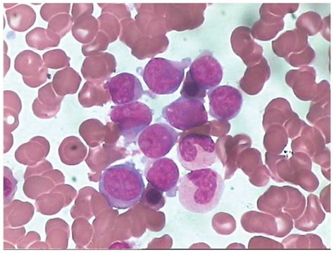 Secondary Lymphoblastic Leukemia Occurring 38 Months After The Primary