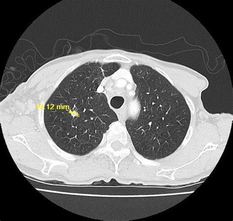 CT Chest Lung Window Showing Right Upper Lobe Nodule On