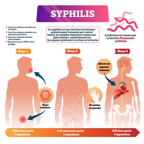 La Syphilis Symptômes Traitements Et Formes De List Information Hospitalière Lexique Et