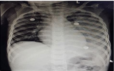 Chest X Ray Showing Left Lobe Opacity With Left Sided Pleural Effusion Download Scientific