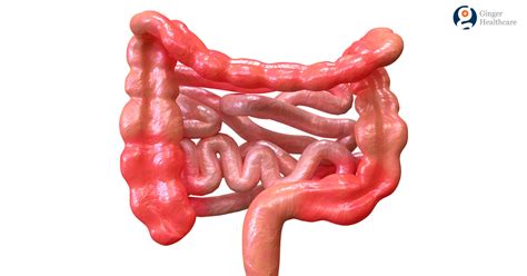 Crohns Disease Causes Symptoms Diagnosis And Treatment Options