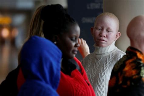 Tanzanian Albino Children Attacked For Body Parts Used In Witchcraft