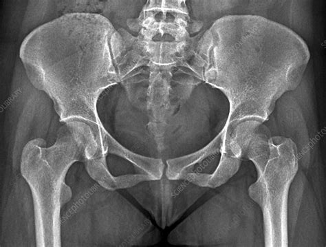 Female Pelvis Bones And Joints X Ray Stock Image C0337354