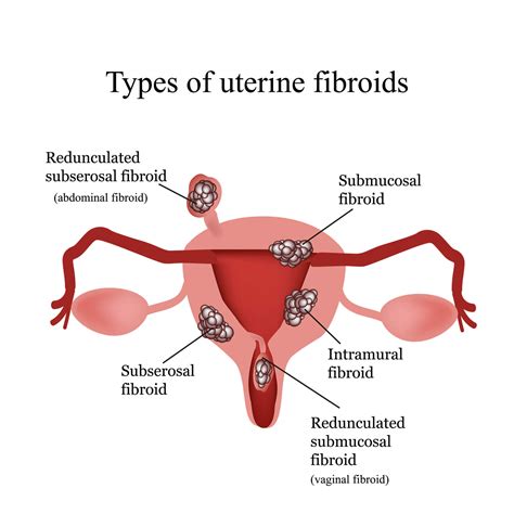 By location, fibroids are divided into interstitial (located in the uterine wall), subserous (growing outside the uterus), submucous (growing towards the uterine cavity). Three Common Types of Fibroids & Approach to its Treatment