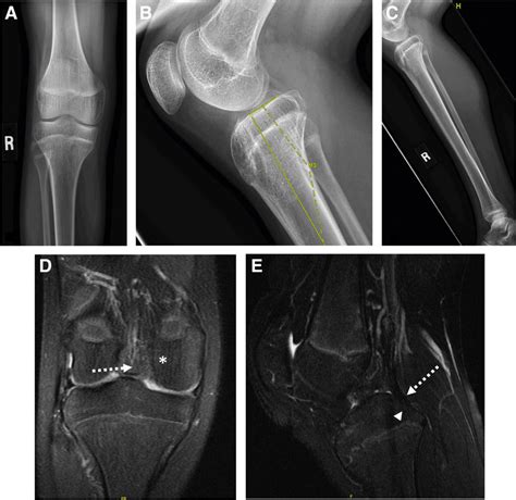 Example Of Reduced Tibial Slope Anteroposterior A And Lateral B