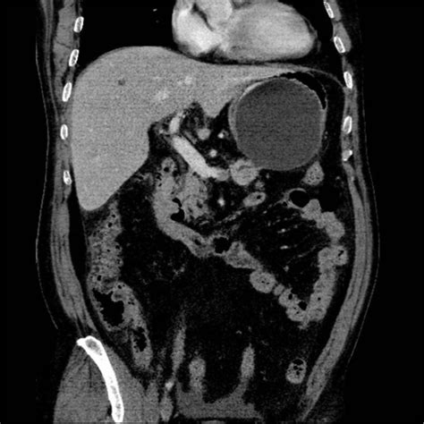 Follow Up Contrast Enhanced Abdominal Computed Tomography Scan A Newly