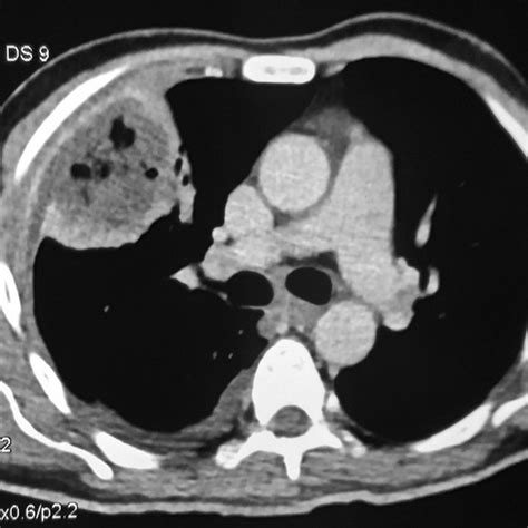 Contrast Enhanced Computed Tomography Of The Thorax Showing Right Lower