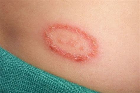 Whats Ringworm And How You Treat It Step To Health