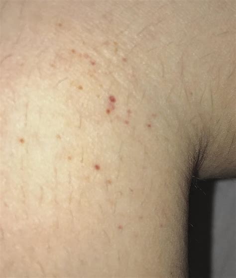Found This Little Red Dots All Over My Legs And Feet They Are Plain