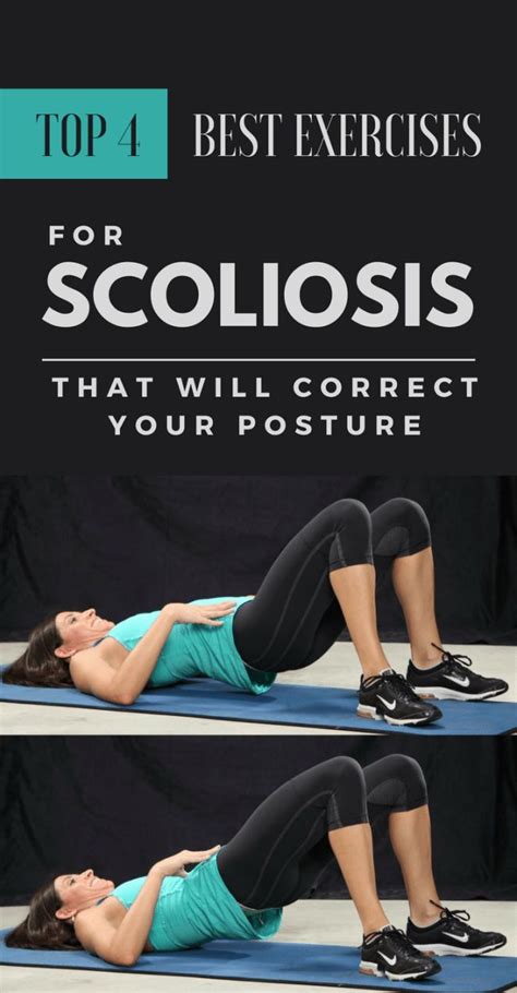 Top 4 Best Exercises For Scoliosis That Will Correct Your Posture