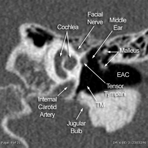 3d Reconstruction Of Cochlea Ear Anatomy Brain Anatomy Medical