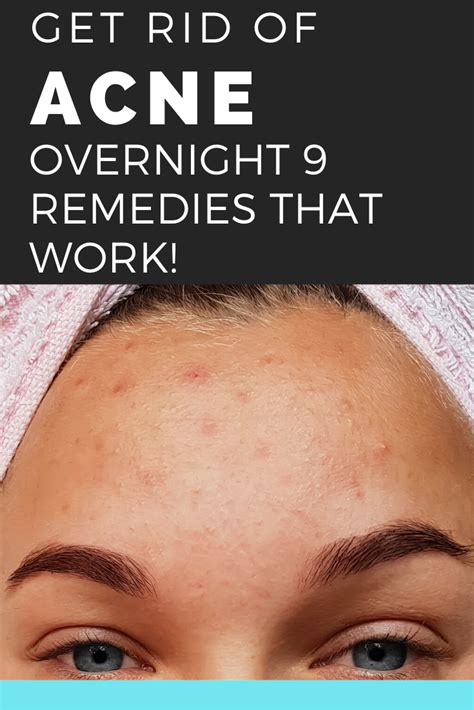 How To Get Rid Of Acne Overnight 9 Remedies That Work Hello Healthy