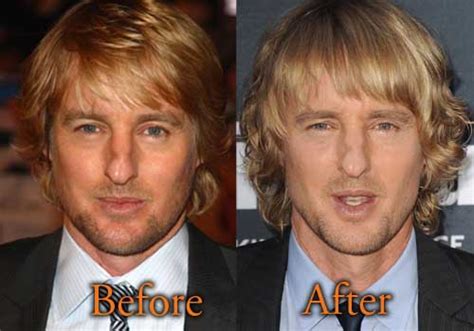 Owen wilson chats loki, tom hiddleston and impressions (youtu.be). Owen Wilson Plastic Surgery, Before and After Nose Job ...