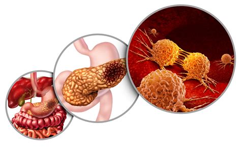What is Pancreatic Cancer? Know More Types, Cause, Symptoms and Treatment