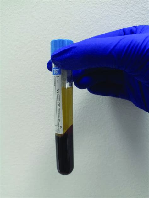 The Patients Collected Blood After Centrifugation In A Centrifuge