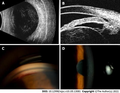 Clinical Features Of The Affected Eye A B Ultrasound Revealed