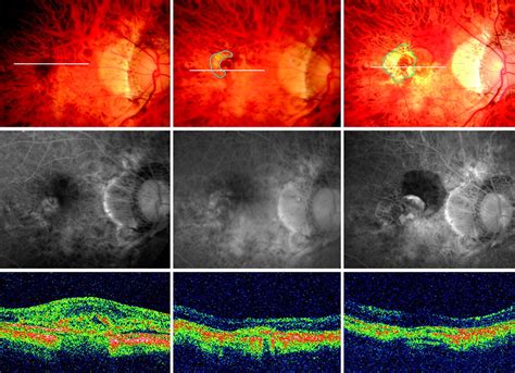 Two Year Comparison Of Photodynamic Therapy And Intravitreal