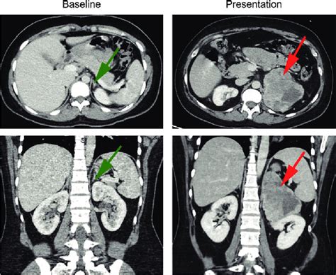 The Abdominal Computed Tomography Ct Of The Patient At Baseline And Download Scientific