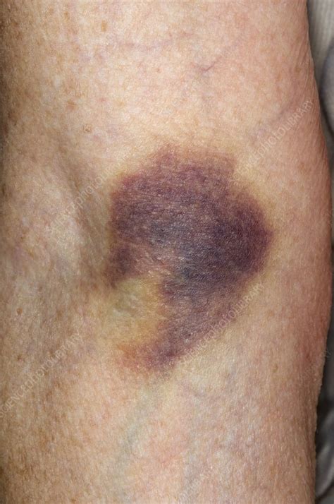 Anatomy Of A Bruise