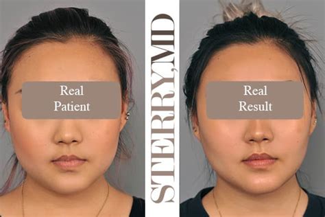buccal fat removal in nyc and manhattan board certified plastic surgeon dr sterry