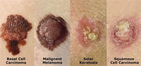 Know Your Abcs Of Skin Exams General Dermatology And Aesthetic