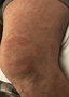 Morbilliform rash involving the left thigh and knee. | Download ...