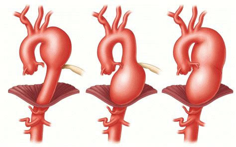 An aneurysm is a weakening and bulging of an artery wall. Abdominal Aortic Aneurysm