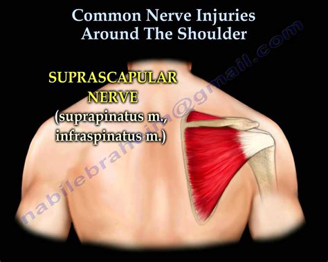 Shoulder Nerve Injury Injuries Everything You Need To Know Dr Nab