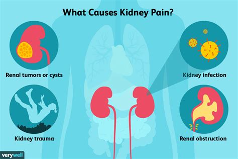 Kidney Stone Pain Diagram