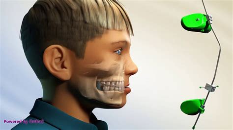 Moin Orthodontics Protraction Headgear Youtube