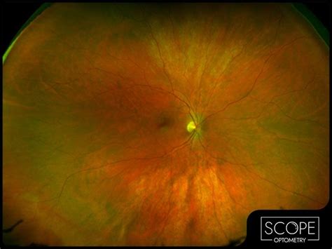 Optos® High Resolution Retinal Imaging An Overview