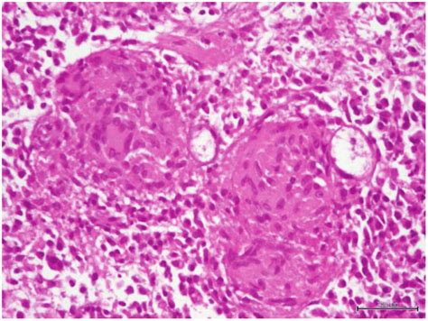 Microscopic Image Hande Revealed Multinucleated Giant Cell Formation