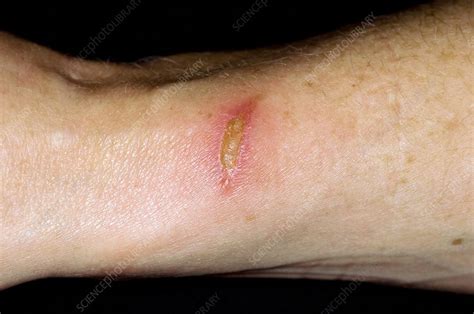 Infected Burn Stock Image F0029946 Science Photo Library