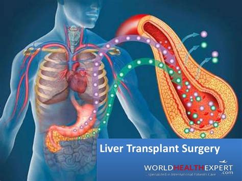 Liver Transplant Surgery And Procedure