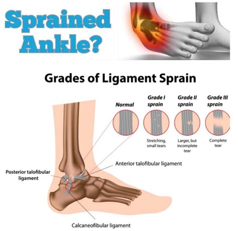 Elevates Ankle Sprain Rehab Elevate Physical Therapy And Fitness