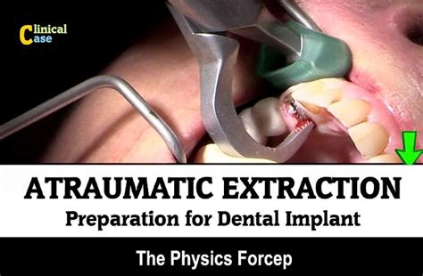 Exodontics Atraumatic Extraction Preparation For Dental Implant